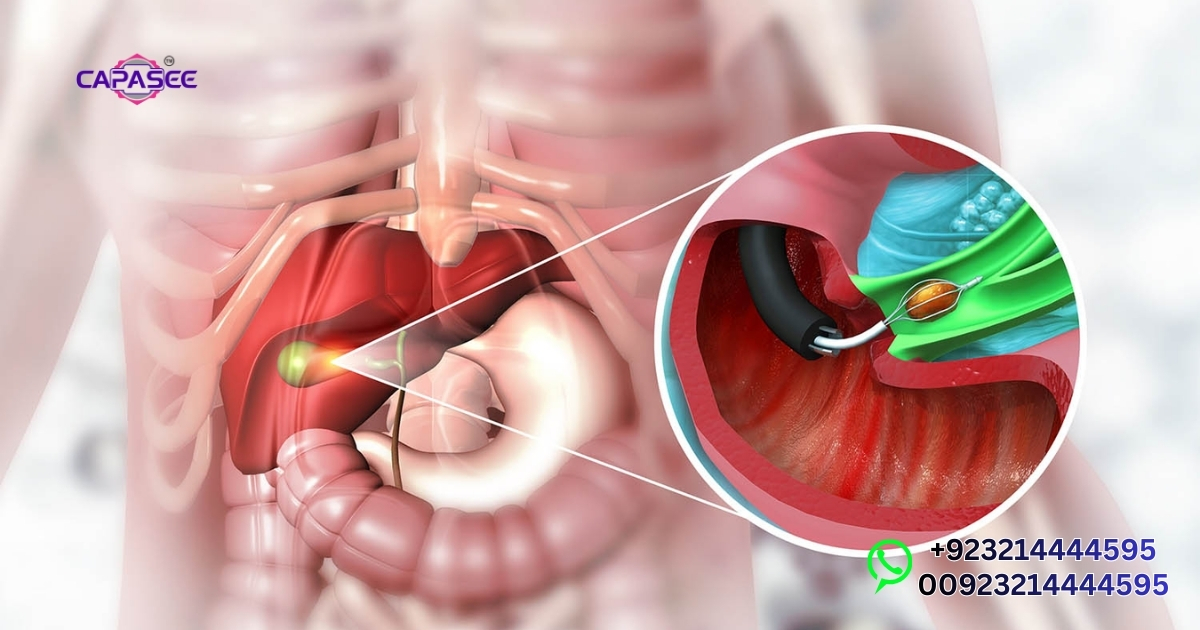 Gallbladder Removal Surgery Pakistan Guide