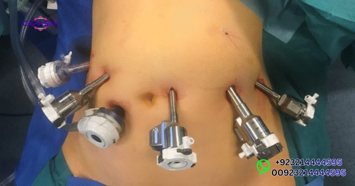 Laparoscopic Hysterectomy Cost in Pakistan Breakdown