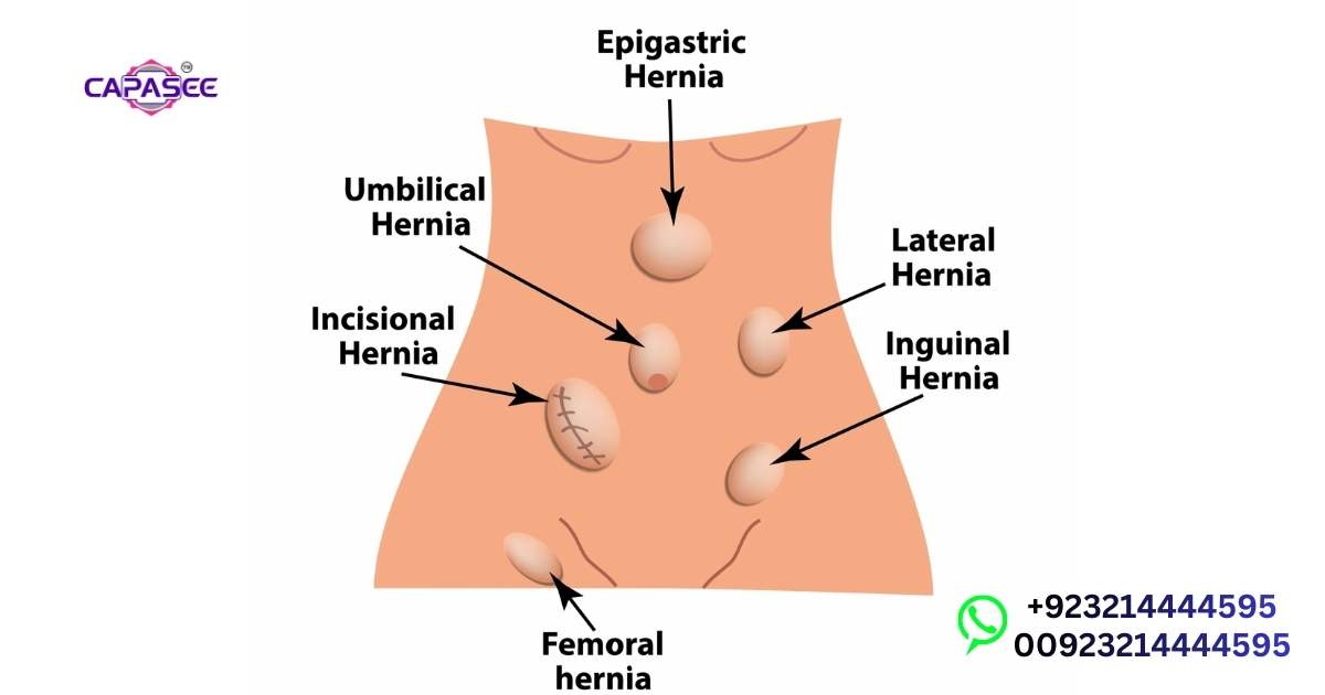 Laparoscopic Inguinal Hernia Surgery Pakistan Guide