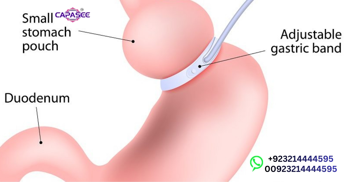 Adjustable Gastric Band Risks & Safety