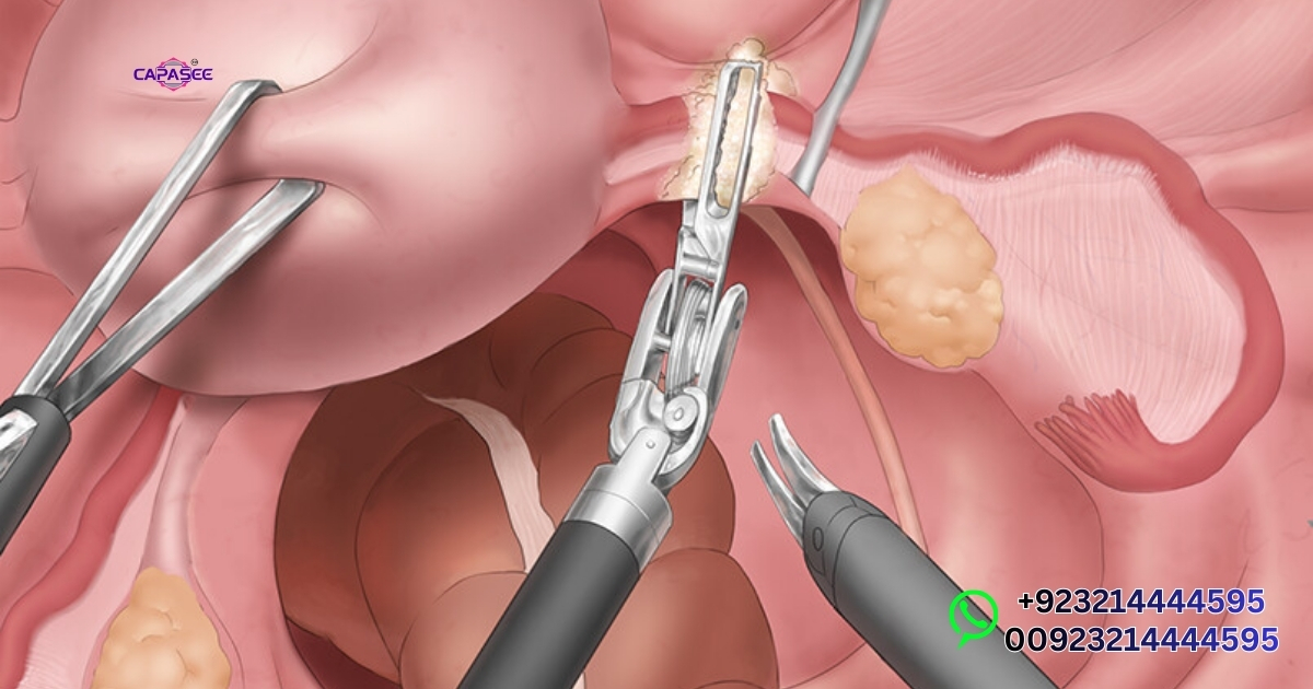 Boost Recovery After Laparoscopic Hysterectomy in Pakistan