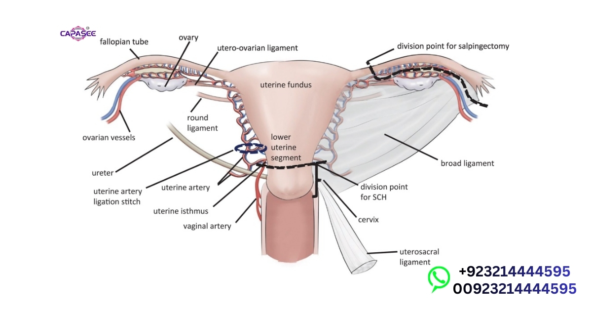 Fast Recovery Laparoscopic Hysterectomy Pakistan Tips