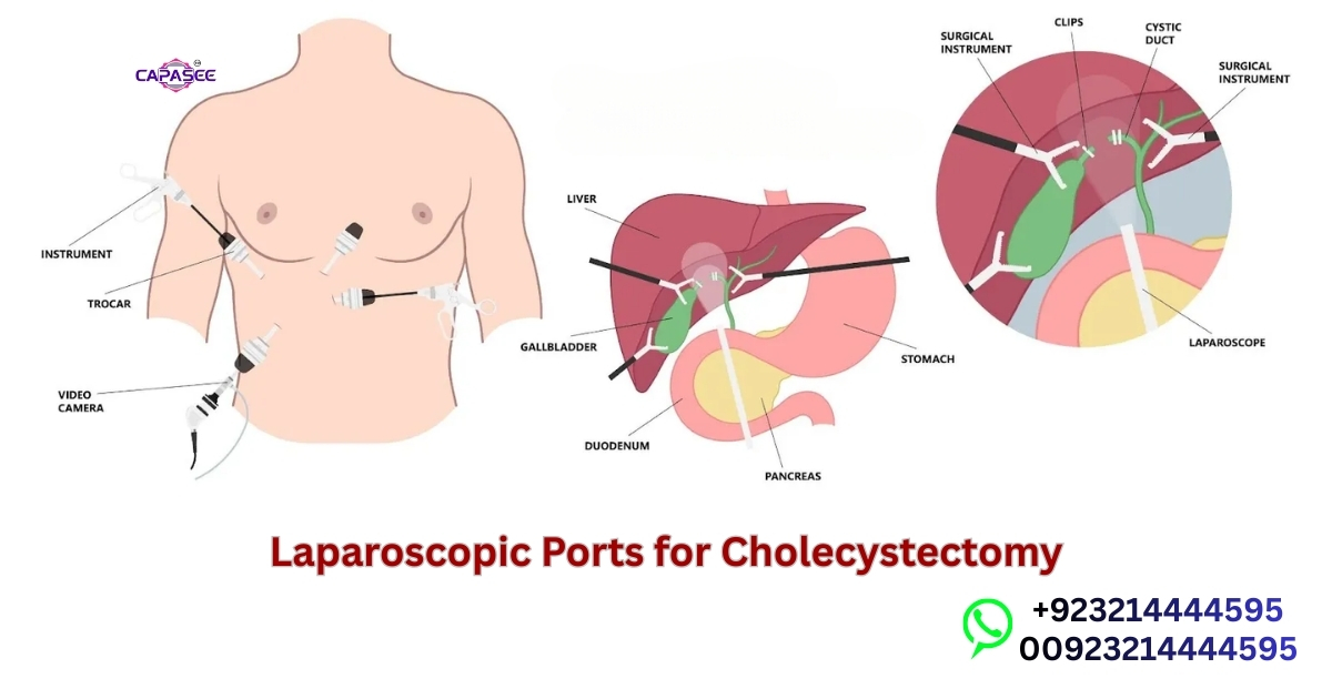 Laparoscopic Ports for Cholecystectomy