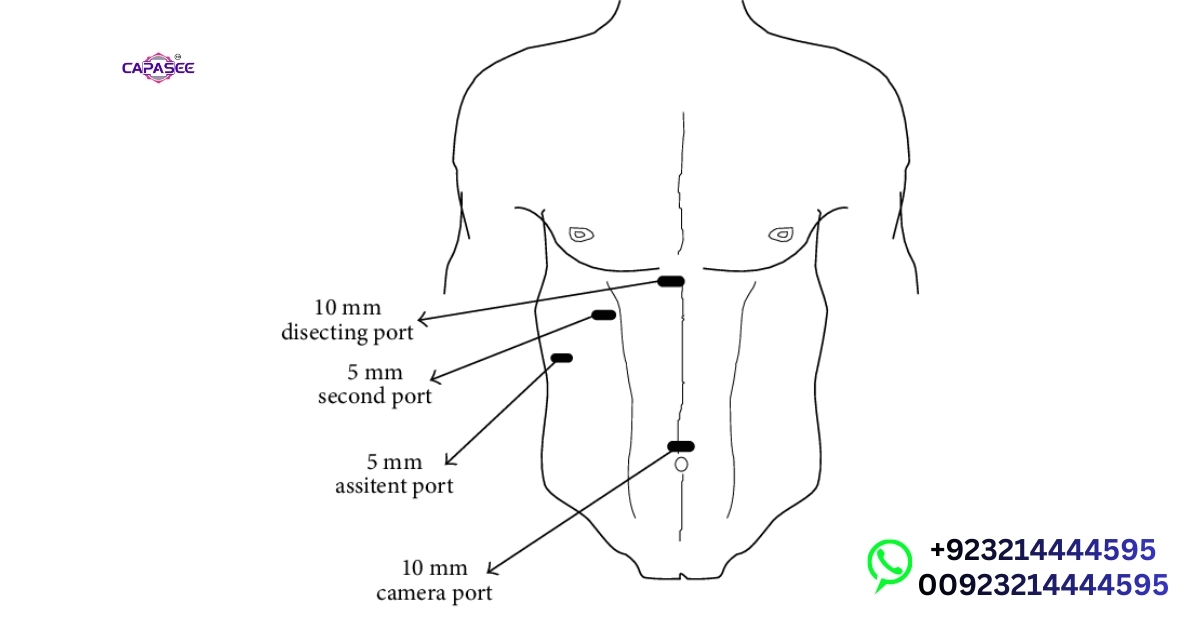 Types of Laparoscopic Ports