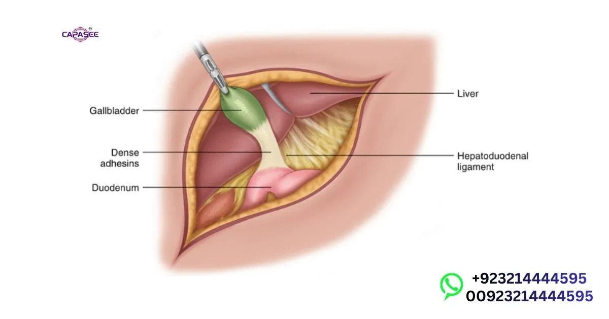 When Laparoscopic Cholecystectomy Needed in Pakistan