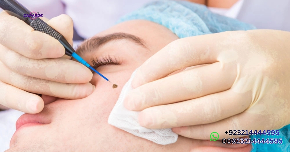 what is a cautery pen and how does it work?